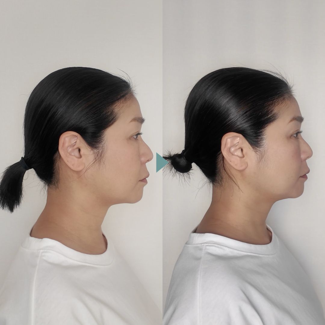首を徹底的にほぐした1か月後の変化。フェイスラインと首まわりのビフォーアフター