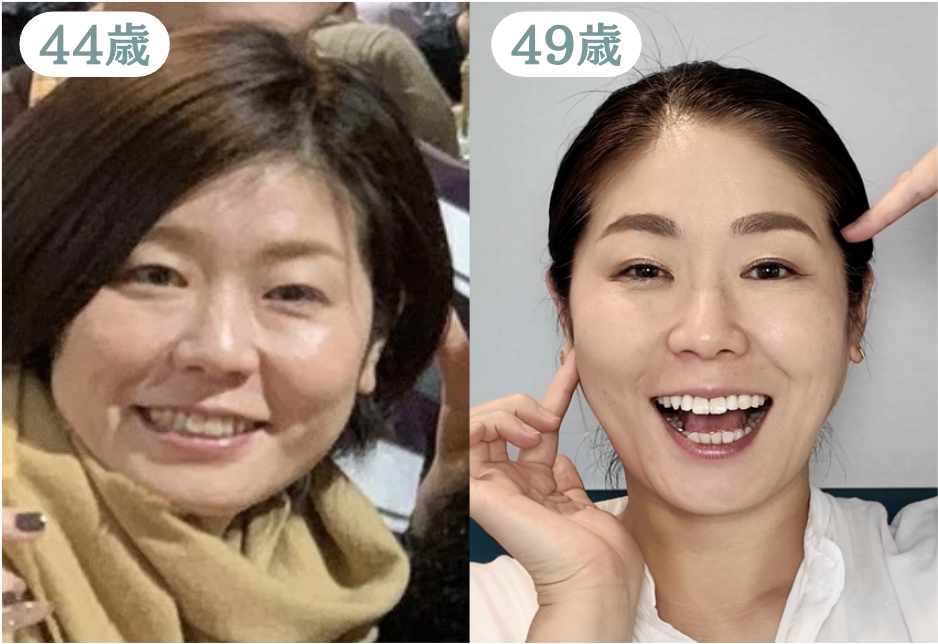 筋膜リリース ビフォーアフター