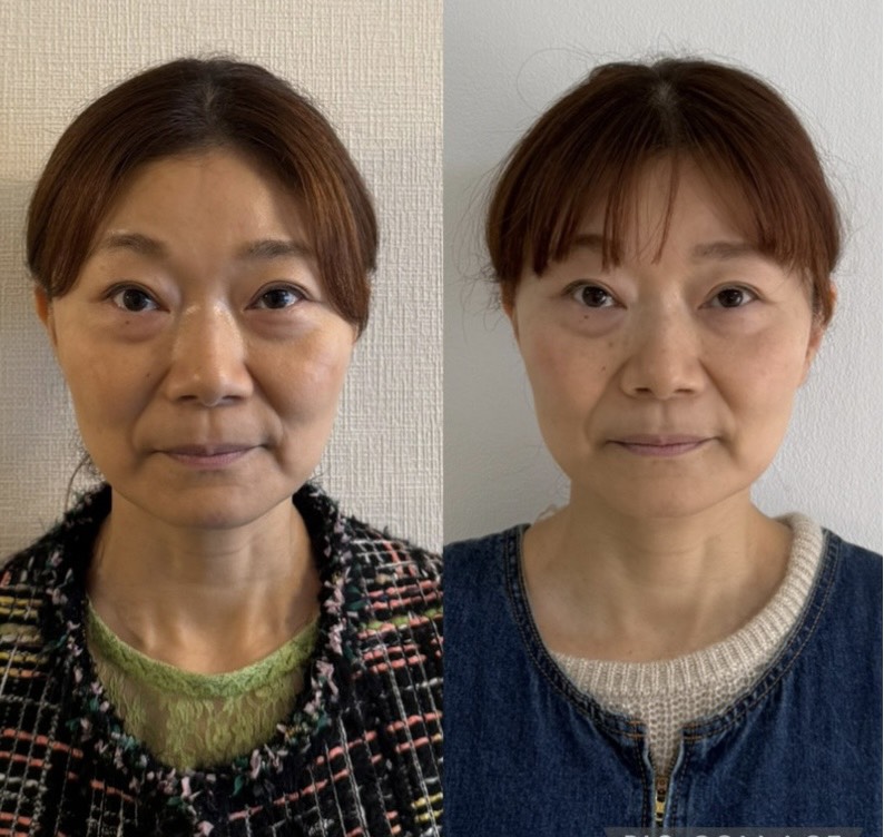 Face Atelier Rサロン会員のフェイスケア ビフォーアフター写真1