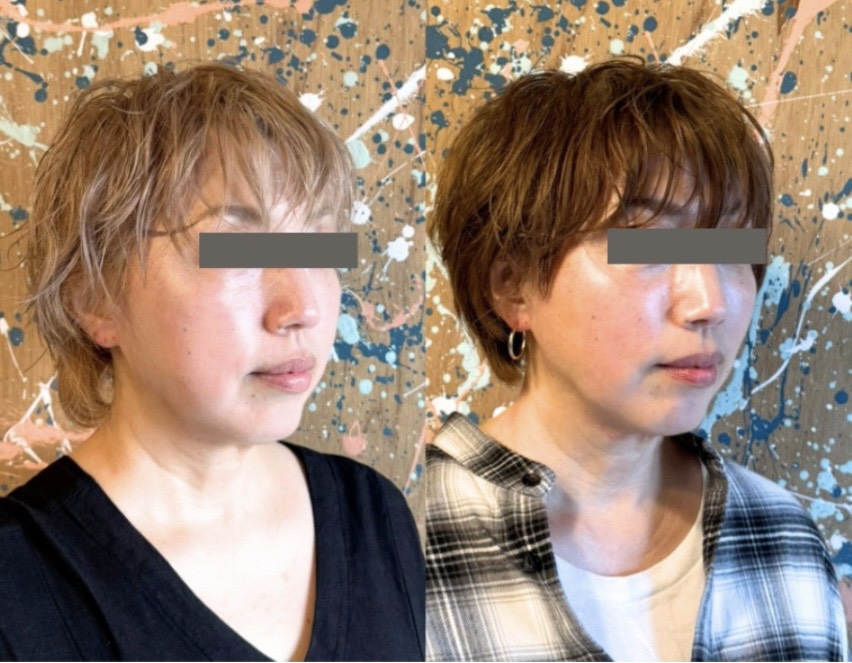 Face Atelier Rサロン会員のフェイスケア ビフォーアフター写真2