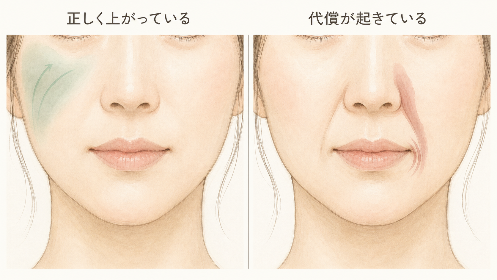 頬が正しく上がっている状態と、代償によって別の筋肉が引っ張り深いシワができている状態の比較イラスト