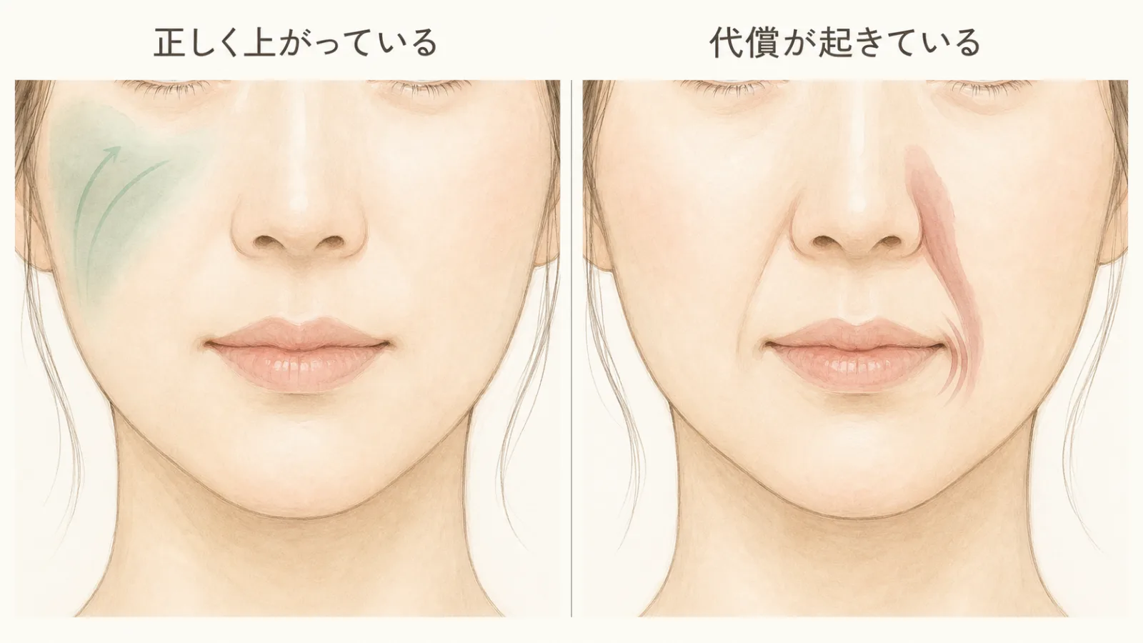 頬が正しく上がっている状態と、代償によって別の筋肉が引っ張り深いシワができている状態の比較イラスト